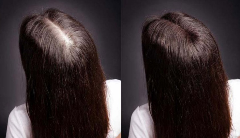 Мезотерапия для волос до и после женщине